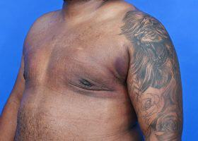 Gynecomastia Surgery Before & After Image