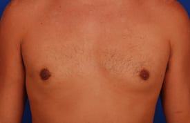 Revision Gynecomastia Surgery Before & After Image