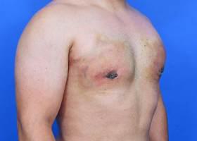 Gynecomastia Surgery Before & After Image