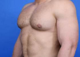 Gynecomastia Surgery Before & After Image