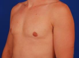 Revision Gynecomastia Surgery Before & After Image