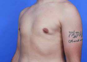 Gynecomastia Surgery Before & After Image