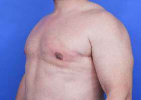 Gynecomastia Surgery Before & After Image