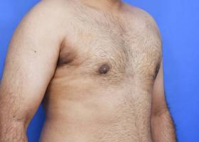 Gynecomastia Surgery Before & After Image