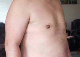 Gynecomastia Surgery Before & After Image