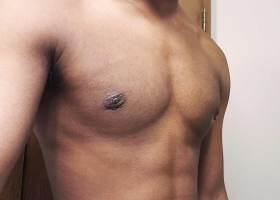 Gynecomastia Surgery Before & After Image