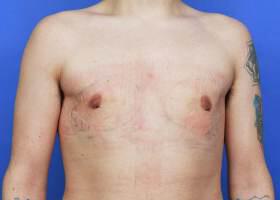 Gynecomastia Surgery Before & After Image