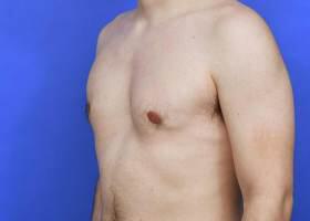 Gynecomastia Surgery Before & After Image