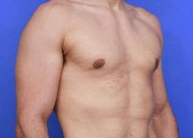 Gynecomastia Surgery Before & After Image