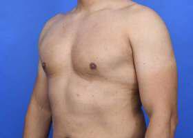 Gynecomastia Surgery Before & After Image