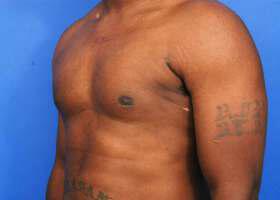 Gynecomastia Surgery Before & After Image