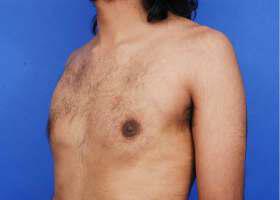 Gynecomastia Surgery Before & After Image