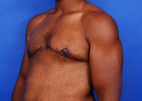 Gynecomastia Surgery Before & After Image