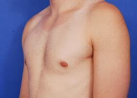 Gynecomastia Surgery Before & After Image