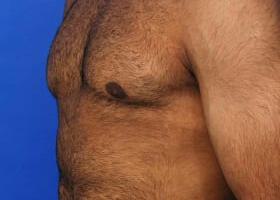 Gynecomastia Surgery Before & After Image