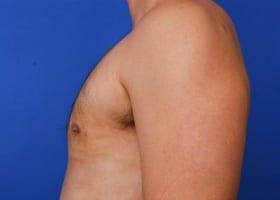 Gynecomastia Surgery Before & After Image