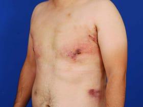 Gynecomastia Surgery Before & After Image