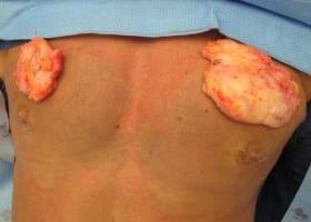 Gynecomastia Surgery Before & After Image