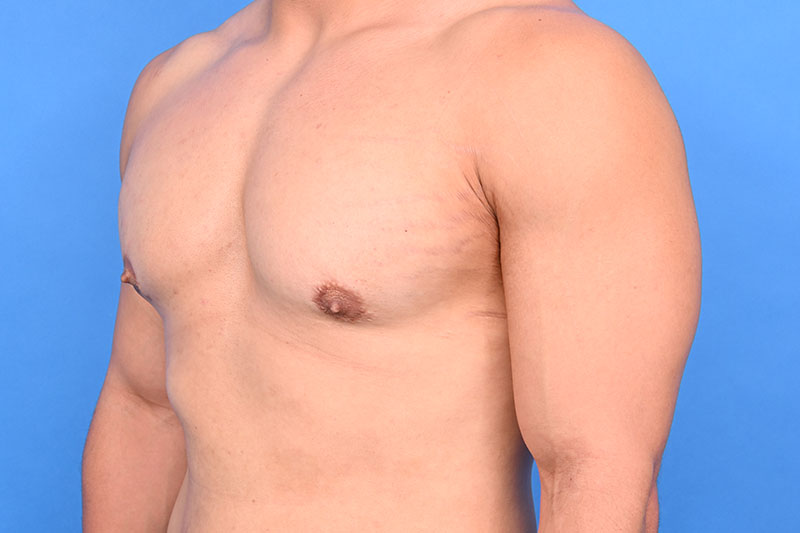 Gynecomastia Surgery Before & After Image