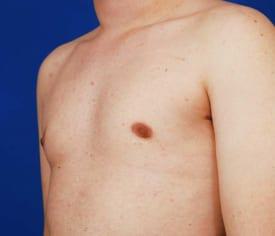 Gynecomastia Surgery Before & After Image