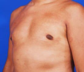 Gynecomastia Surgery Before & After Image