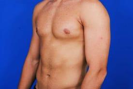 Gynecomastia Surgery Before & After Image