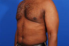 Gynecomastia Surgery Before & After Image