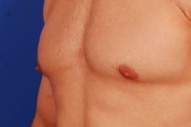 Gynecomastia Surgery Before & After Image
