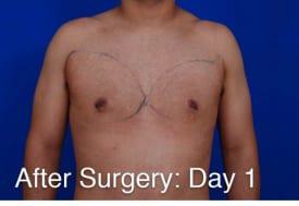 Gynecomastia Surgery Before & After Image