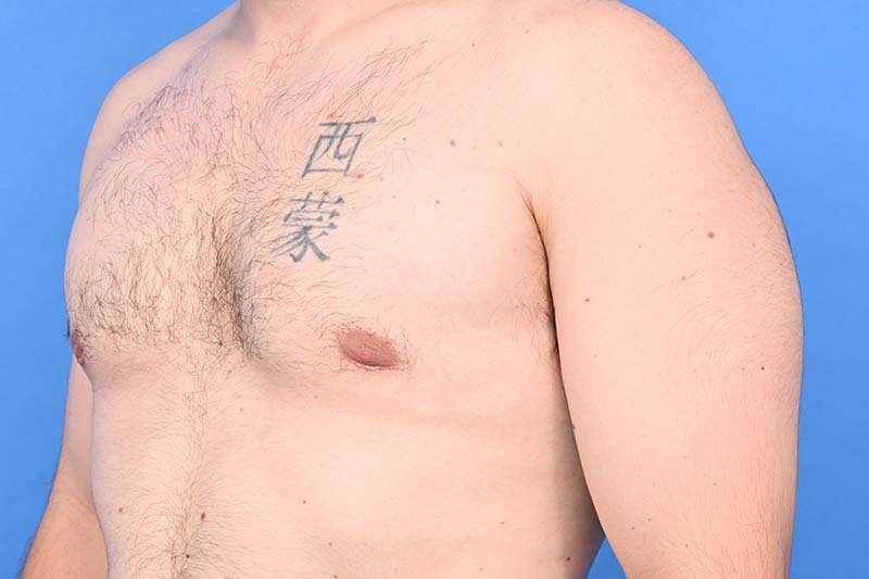 Gynecomastia Surgery Before & After Image