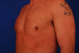 Gynecomastia Surgery Before & After Image