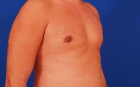 Gynecomastia Surgery Before & After Image