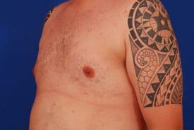 Gynecomastia Surgery Before & After Image