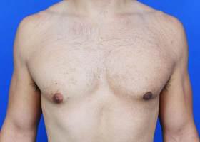 Revision Gynecomastia Surgery Before & After Image