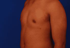 Gynecomastia Surgery Before & After Image