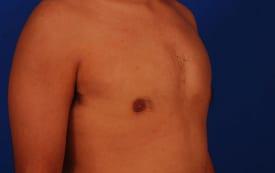 Gynecomastia Surgery Before & After Image