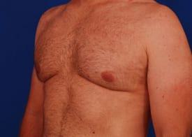 Gynecomastia Surgery Before & After Image