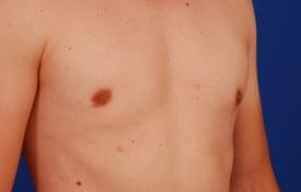 Gynecomastia Surgery Before & After Image