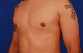 Gynecomastia Surgery Before & After Image
