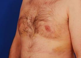 Gynecomastia Surgery Before & After Image