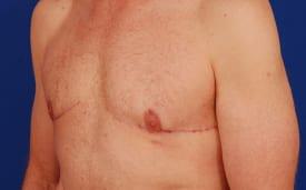Gynecomastia Surgery Before & After Image