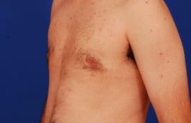 Gynecomastia Surgery Before & After Image