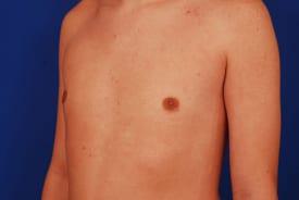 Gynecomastia Surgery Before & After Image