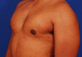Gynecomastia Surgery Before & After Image