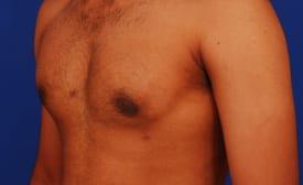 Gynecomastia Surgery Before & After Image