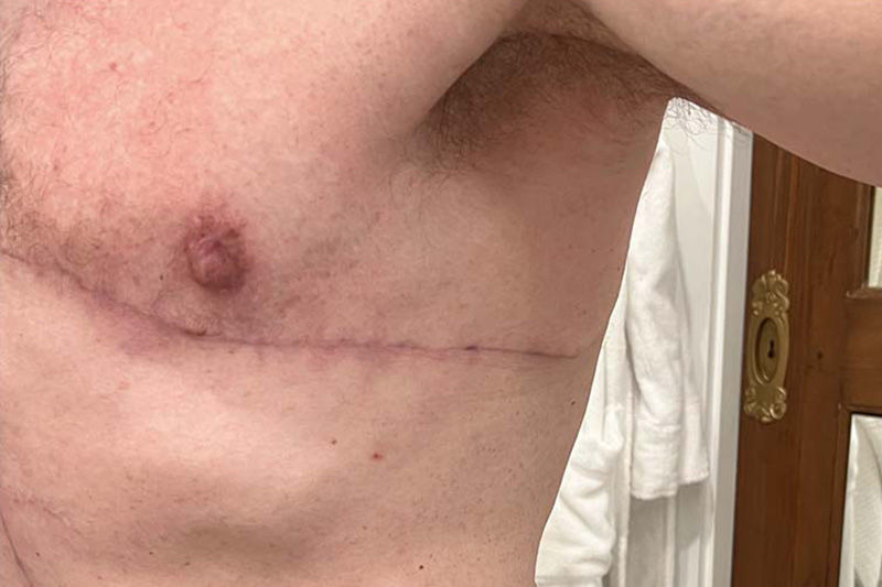 Gynecomastia Surgery Before & After Image