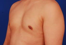 Gynecomastia Surgery Before & After Image