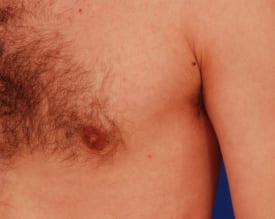 Gynecomastia Surgery Before & After Image