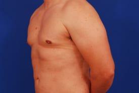 Gynecomastia Surgery Before & After Image