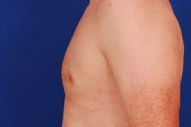 Gynecomastia Surgery Before & After Image